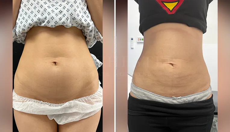 vaser lipo before and after stomach result