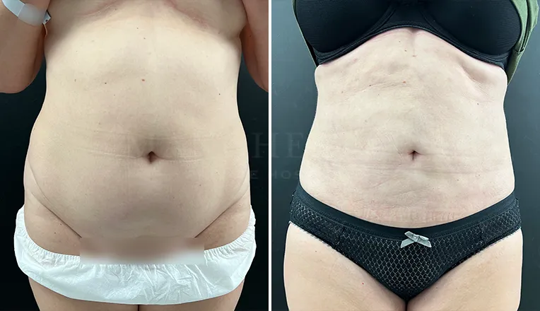 vaser lipo before and after stomach