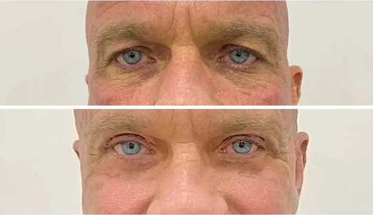 blepharoplasty before and after patient - 11