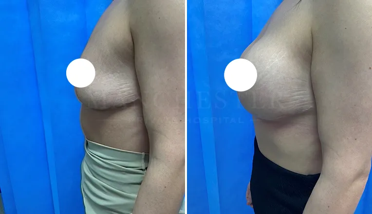 breast enlargement before and after patient - 2 - v3