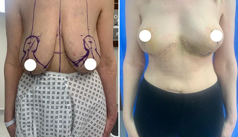 breast reduction surgery before and after patient - 2