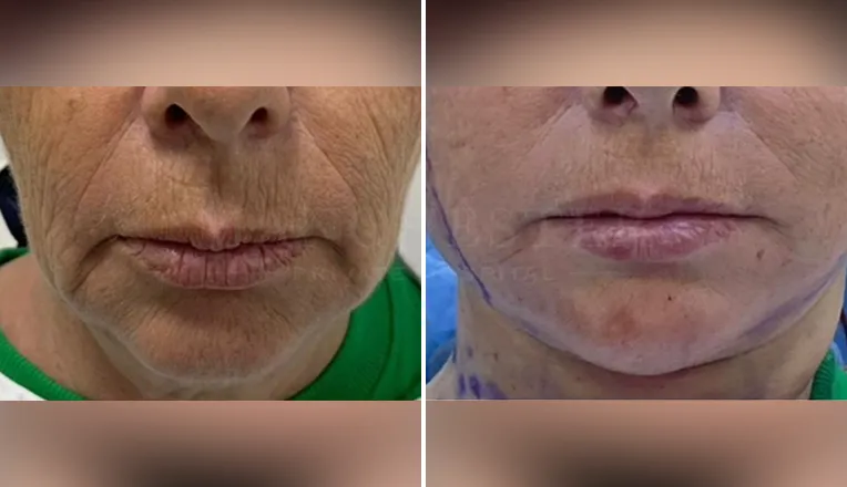 facelift before and after patient - v1