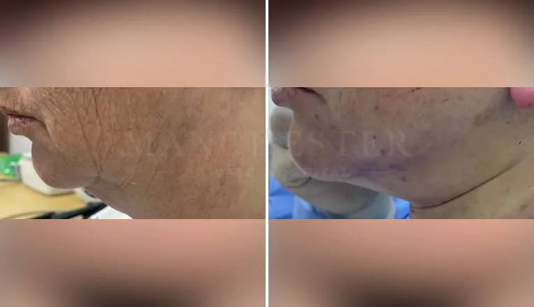 facelift before and after patient - v3