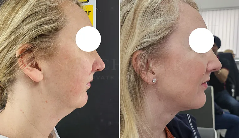 facial vaser lipo before and after patient -2 - v2