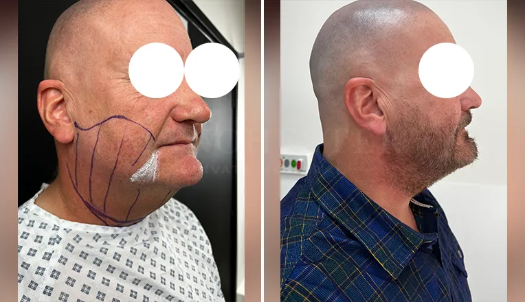 facial vaser liposuction before and after patient -2 - v3