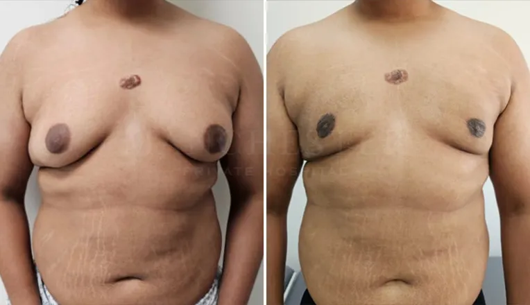 gynecomastia before and after patient -1