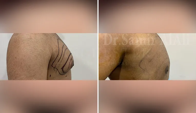 gynecomastia before and after patient -5 - v2