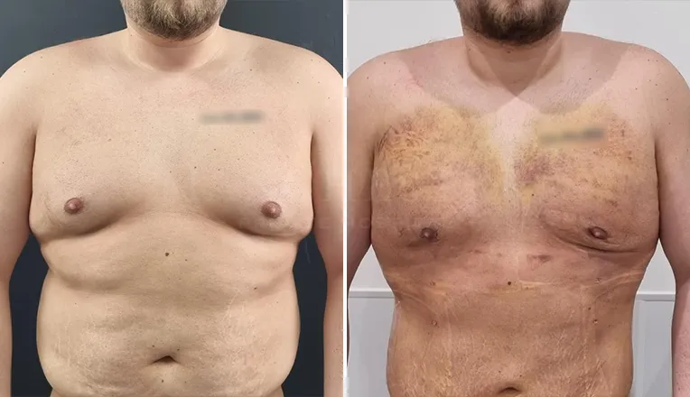 gynecomastia liposuction before and after patient -5