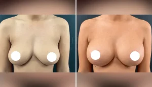 mastopexy breast augmentation before and after patient - v1