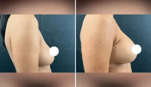 mastopexy breast augmentation before and after patient - v4