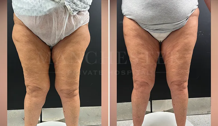 vaser lipo thighs before after patient - 2 - v1