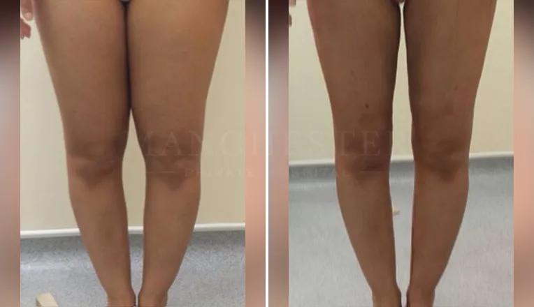 vaser lipo thighs before after patient - 3 - v1