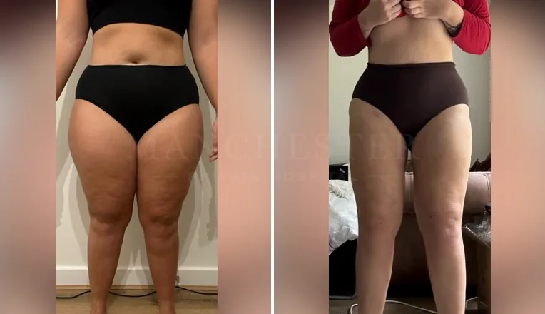 vaser lipo thighs before after patient - 4 - v1