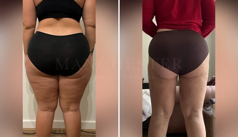 vaser lipo thighs before after patient - 4 - v2