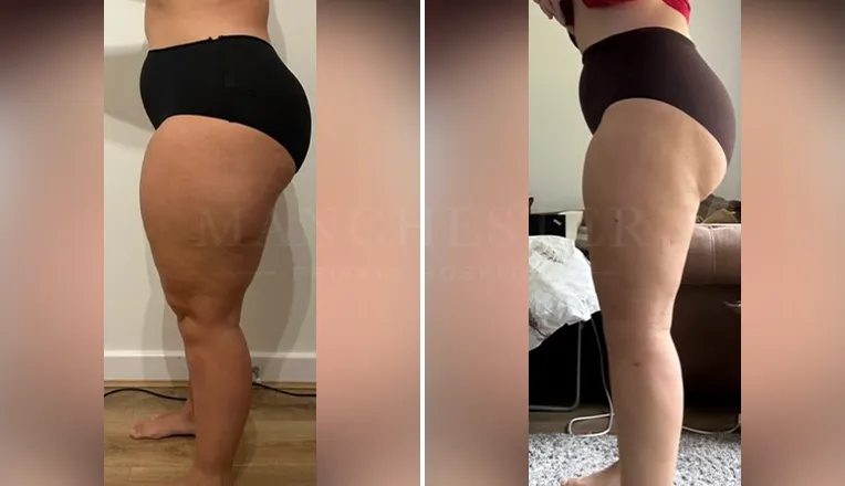 vaser lipo thighs before after patient - 4 - v3