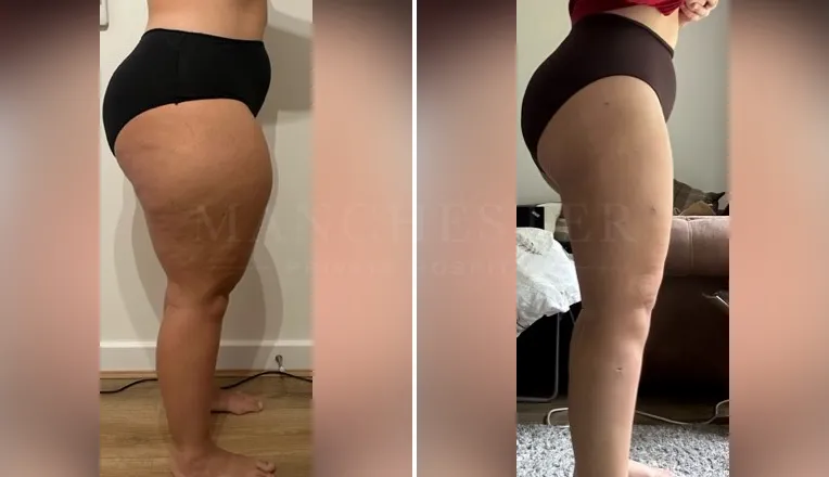 vaser lipo thighs before after patient - 4 - v4