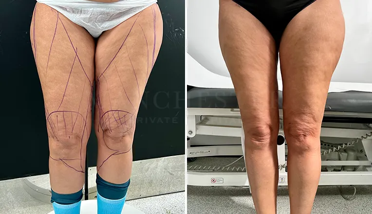 vaser liposuction legs before and after patient