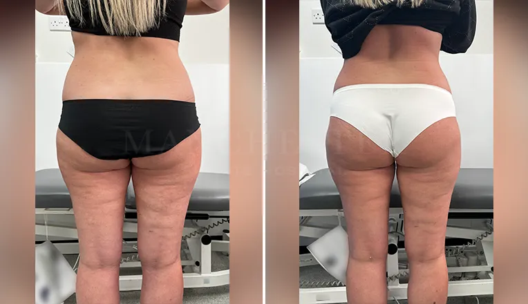 vaser liposuction thighs before after patient-2