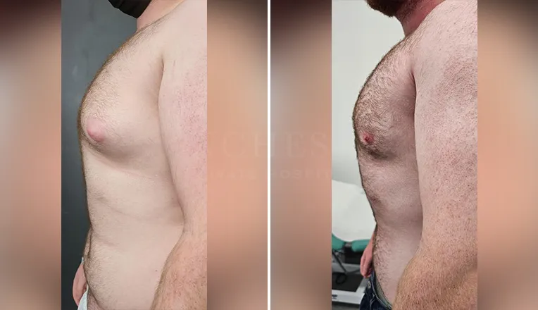 gynecomastia liposuction before and after patient -5- v2