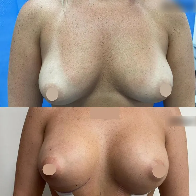 mph breast enlargement patient-23