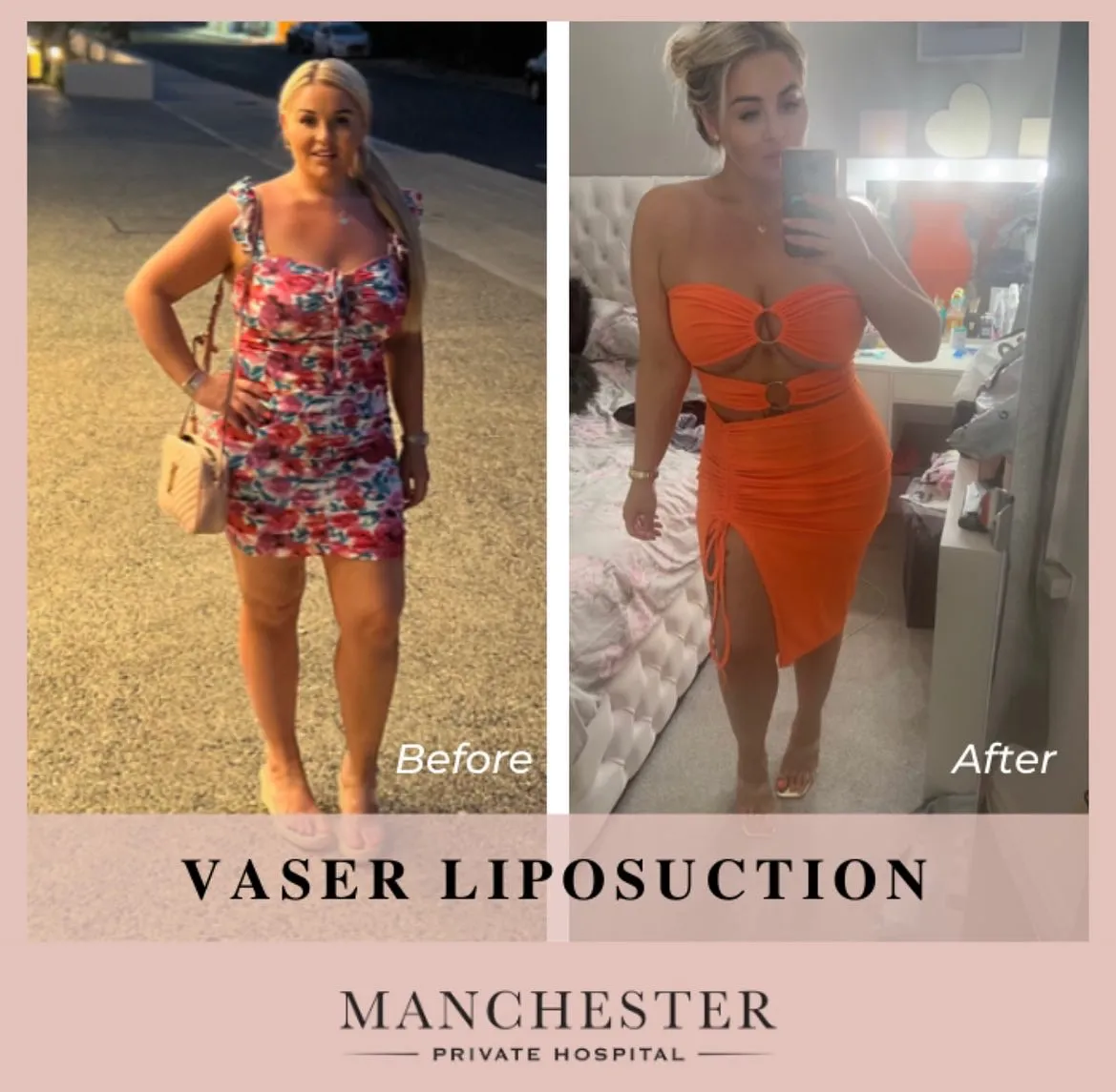 vaser liposuction patient result-3