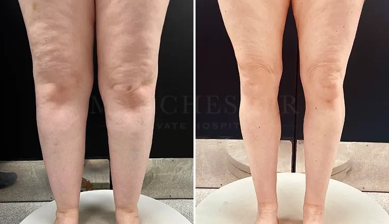 lipedema surgery before and after patient 2-v1