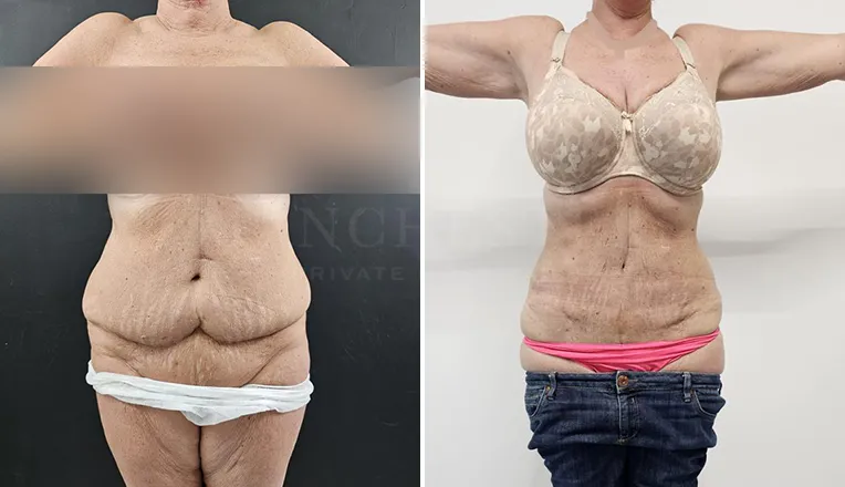 vaser lipo female abs before and after-1-v1