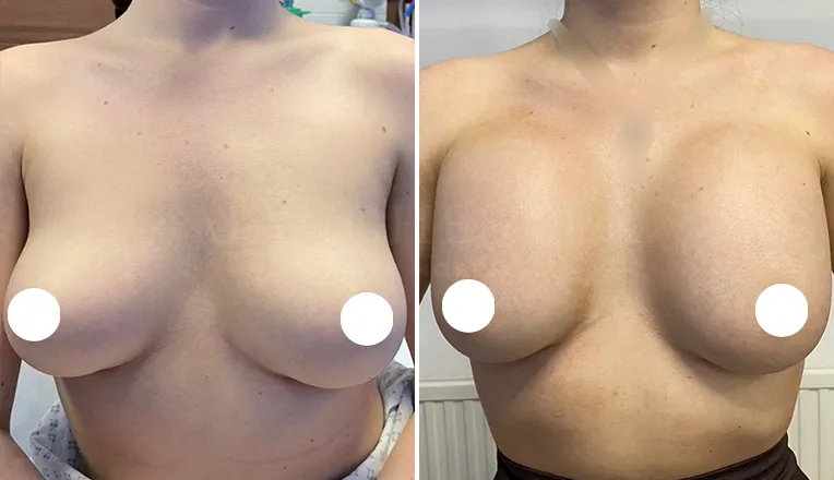 breast augmentation before and after patient-11