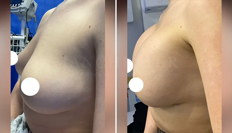 breast augmentation before and after patient-12