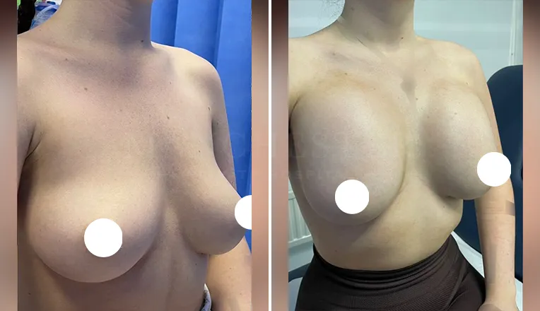 breast augmentation before and after patient-13