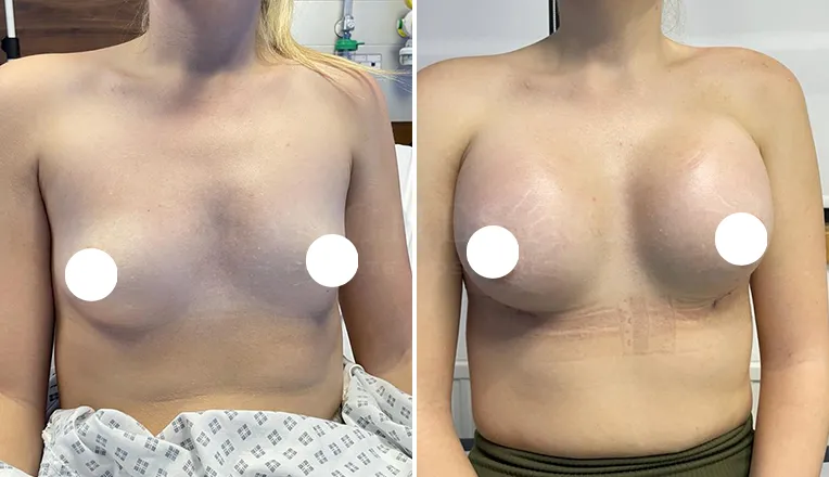 breast augmentation before and after patient-8