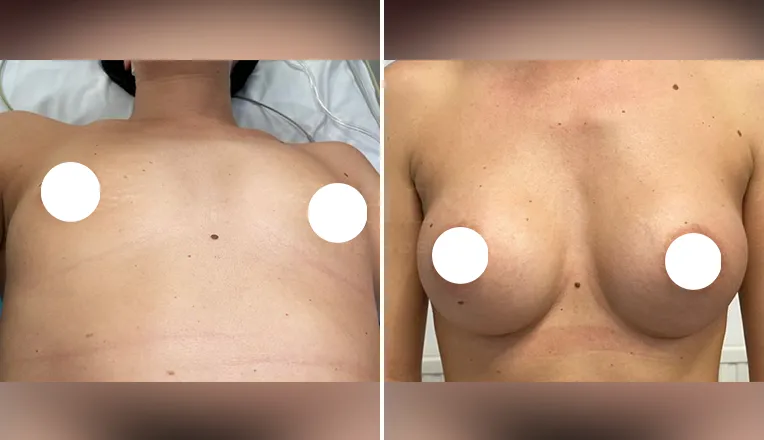 breast augmentation before and after patient-9