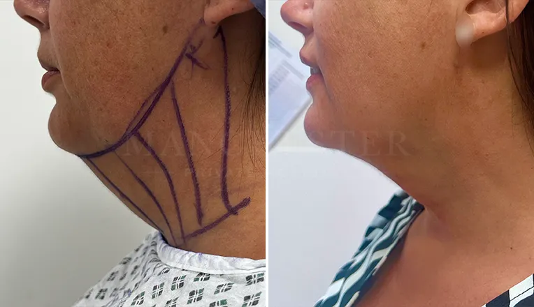 facial vaser liposuction results-1-v2