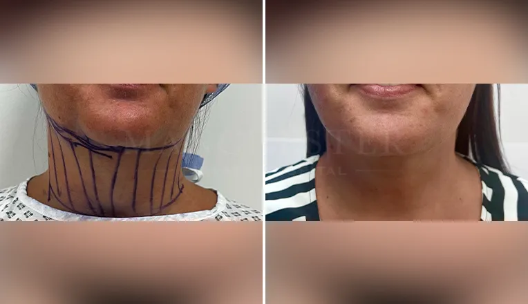 facial vaser liposuction results-1