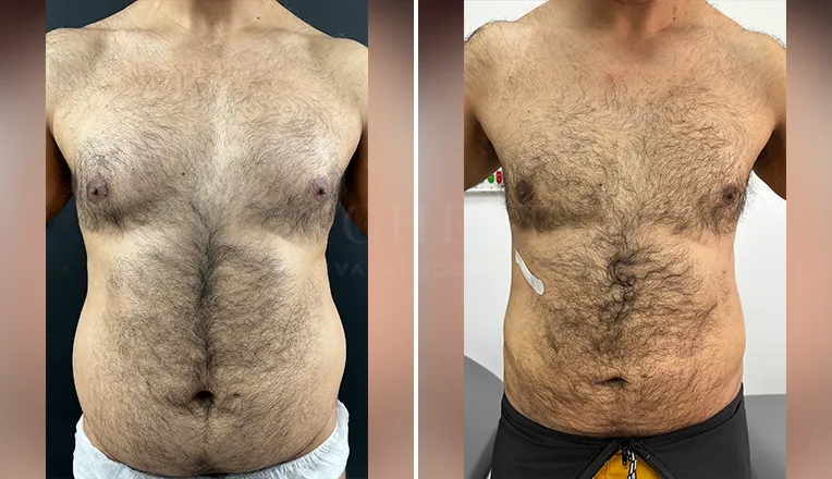 gynecomastia liposuction before and after patient-10