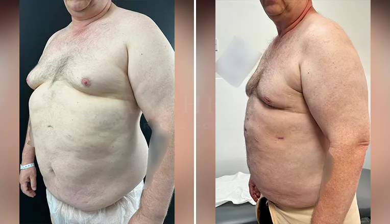 gynecomastia liposuction before and after patient-8-v2