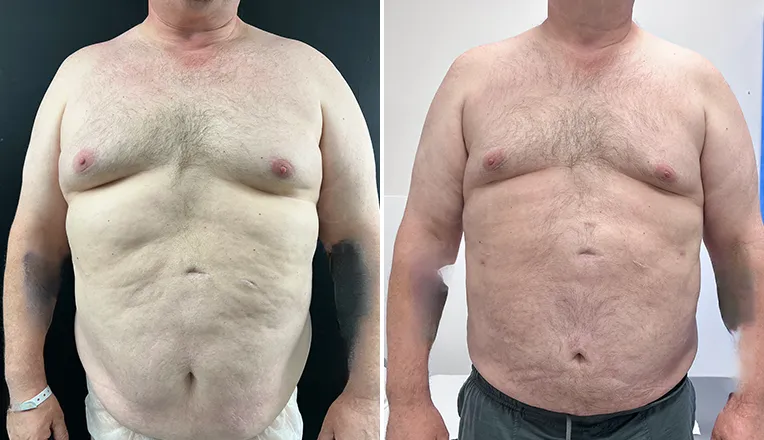 gynecomastia liposuction before and after patient-8