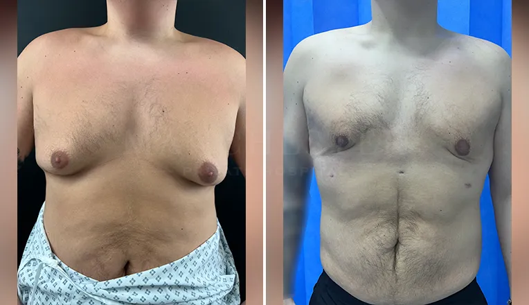 gynecomastia liposuction before and after patient-9
