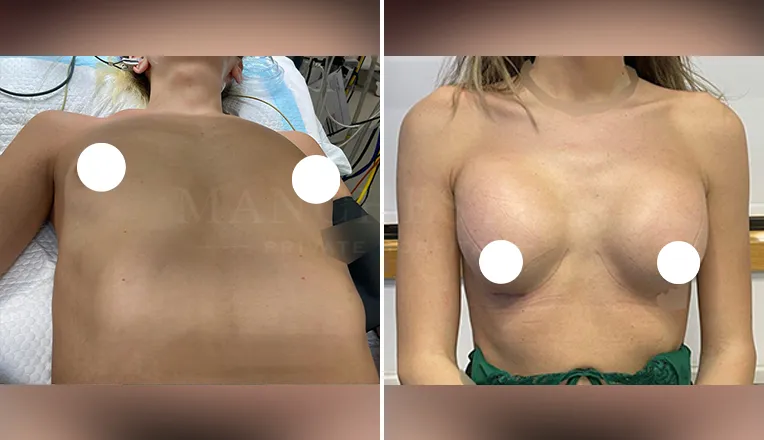 transgender breast augmentation before and after