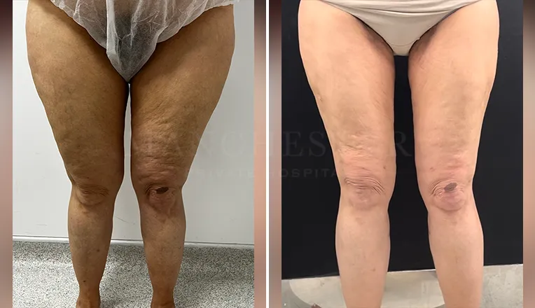 vaser-lipo-thighs-before-after-patient-5-v1