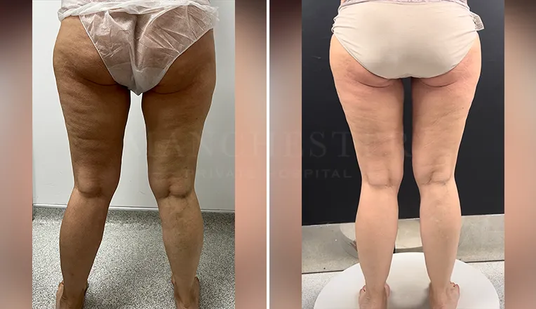 vaser-lipo-thighs-before-after-patient-5-v2