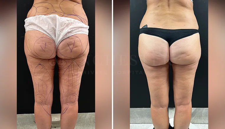 vaser-lipo-thighs-before-after-patient-6