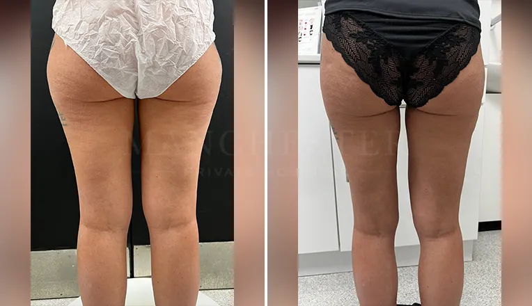 vaser-lipo-thighs-before-after-patient-8