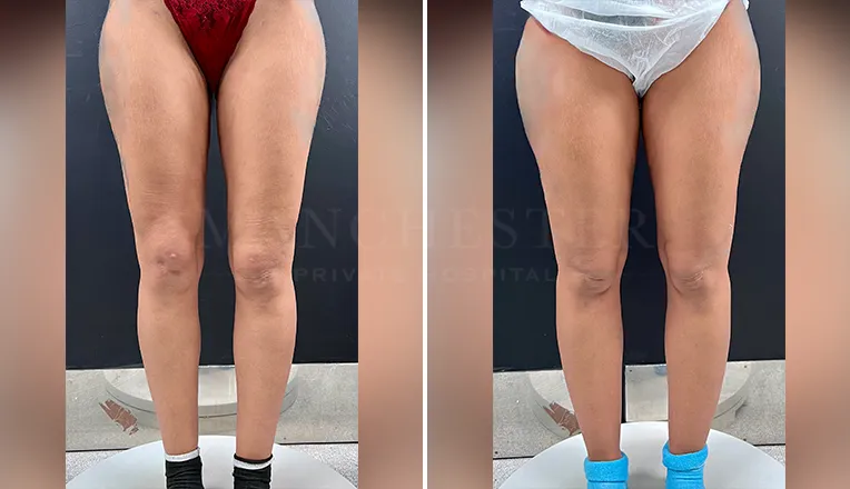 vaser-lipo-thighs-before-after-patient-9