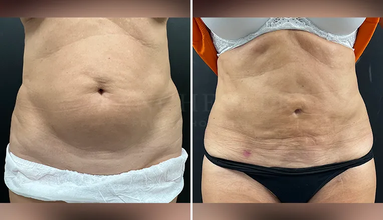 vaser liposuction patient results-3