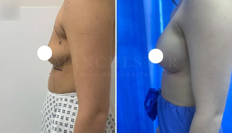 boob job before and after patient-5-v3