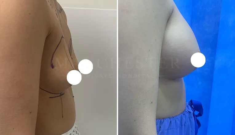 boob job before and after patient-5-v4