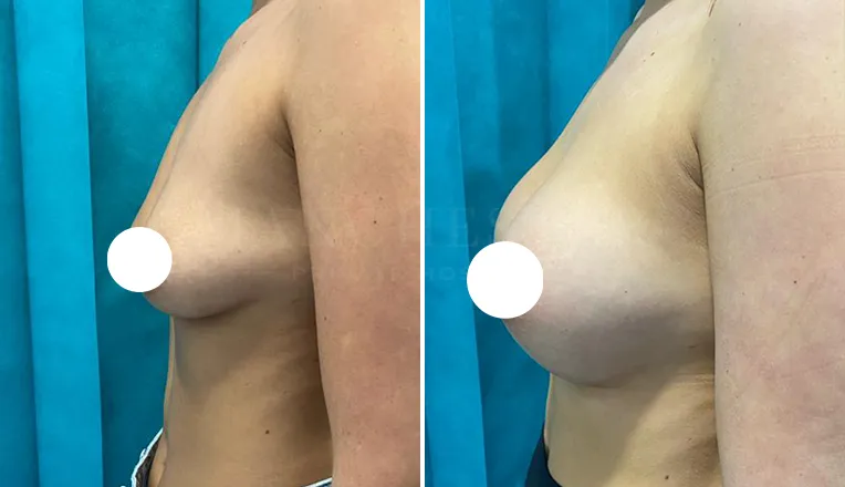 breast enlargement before and after patient-6-v1