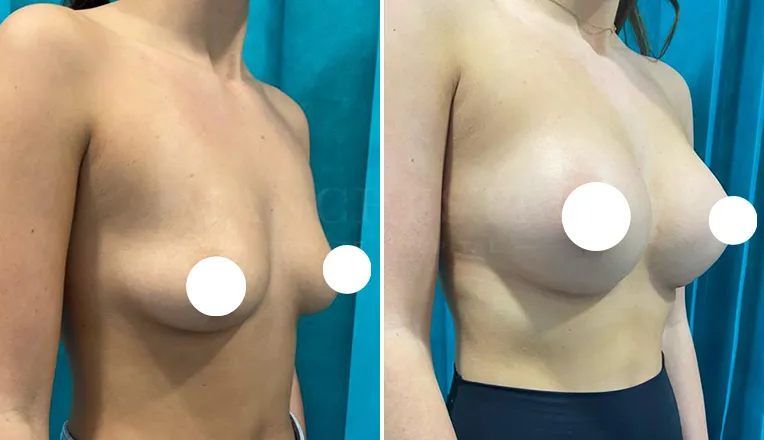 breast enlargement before and after patient-6-v2