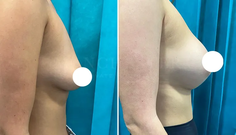 breast enlargement before and after patient-6-v3